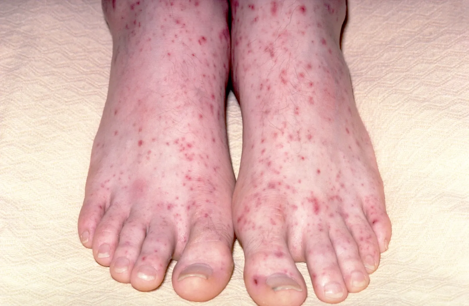 Petechial rash on the feet caused by meningococcal septicaemia, showing multiple red and purple spots on the skin.